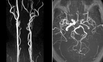 Carotid-Dissection-cover
