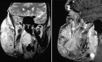 Facial-Angioma-cover
