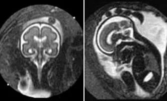 Foetal-MRI-cover