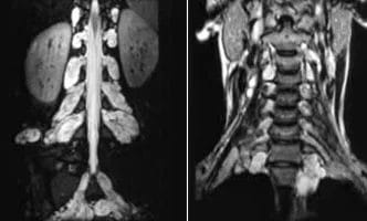 Neurofibromatosis-cover