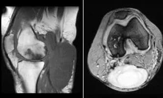 Popliteal-Cyst-cover