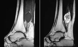 Posterior-Tibial-Neuroma-cover