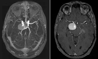 Right-Internal-Carotid-Artery-Aneurysm-cover