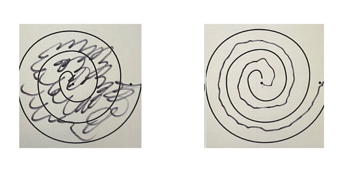 Spirals drawn by a patient immediately before and after MR guided focused ultrasound treatment in Queen Square