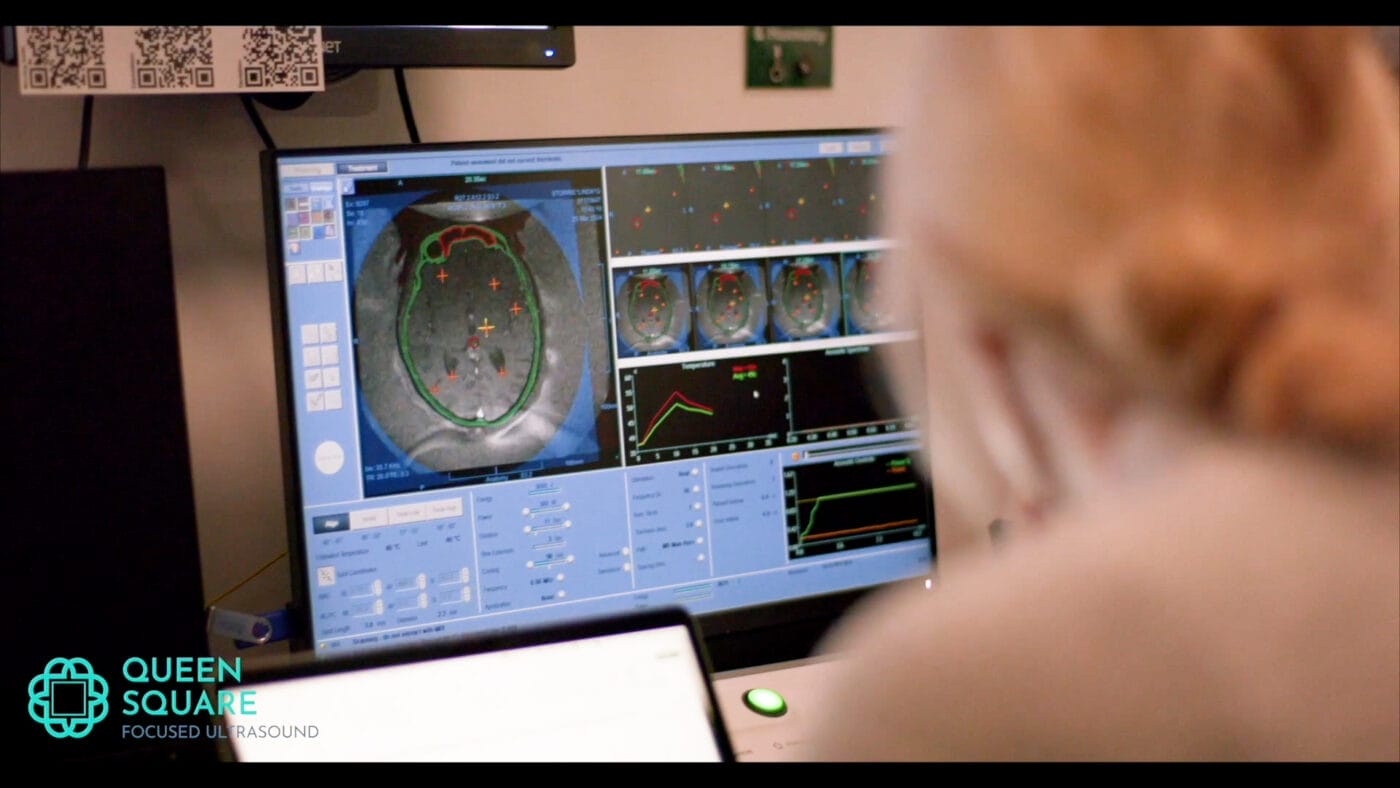 The treatment team at the Queen Square Imaging Centre monitor temperature changes in the brain, in real time using MRI.
